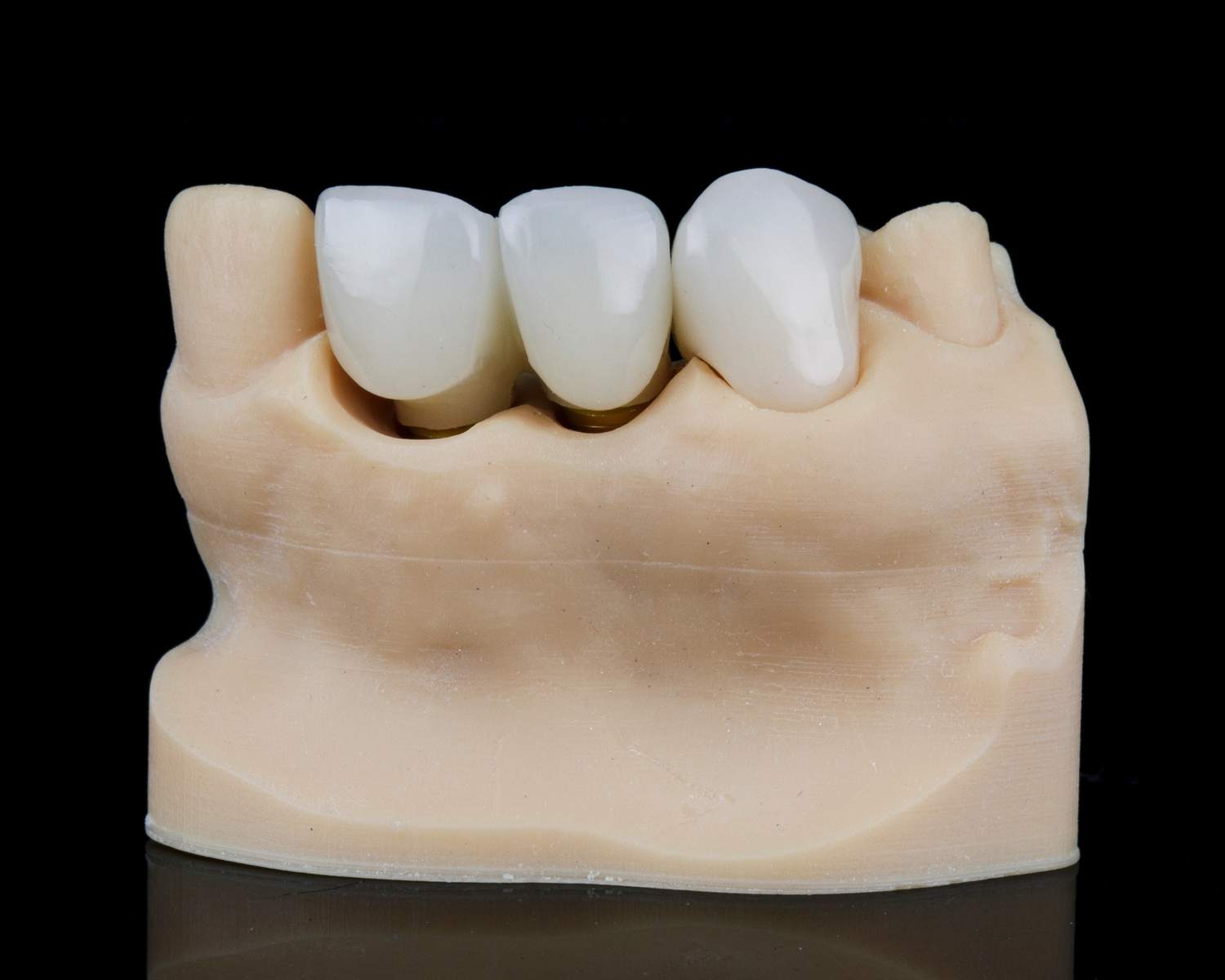 dental bridge (1)