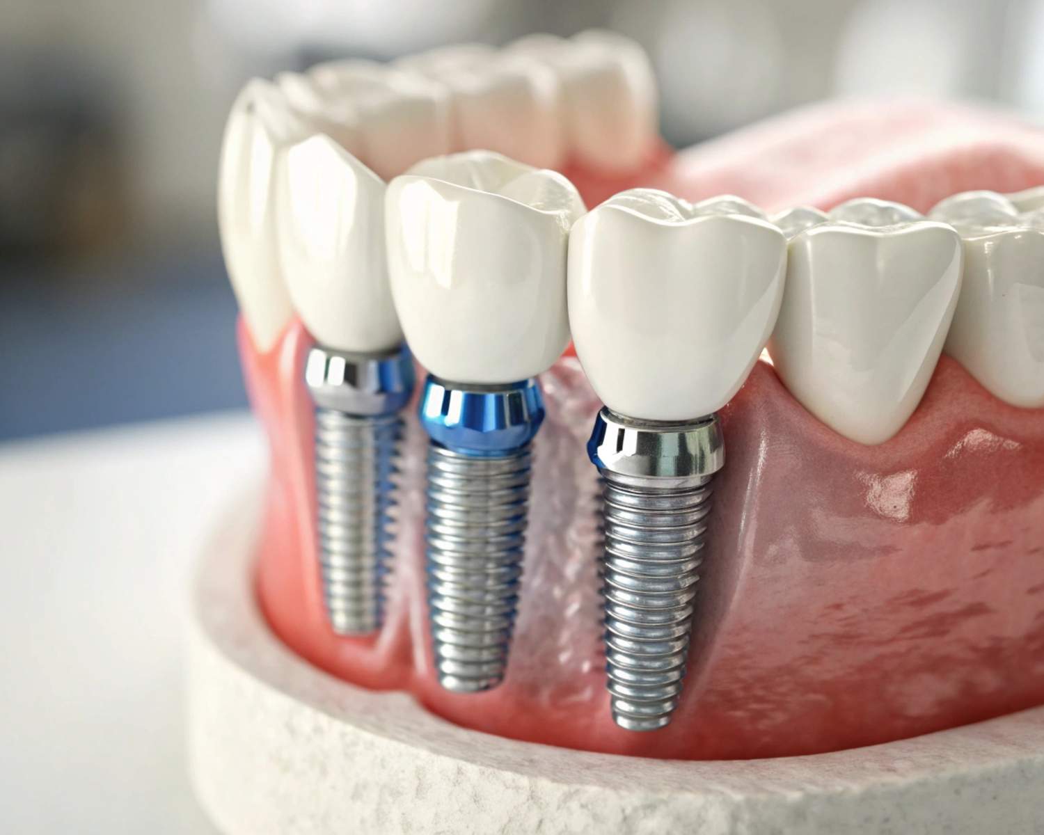 dental implants (2)